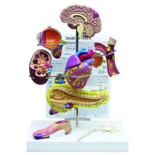 Type II Diabetes Human Anatomy/Anatomical Model #4010