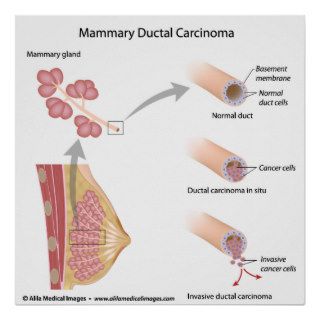 Breast cancer ductal carcinoma , labeled diagram. posters