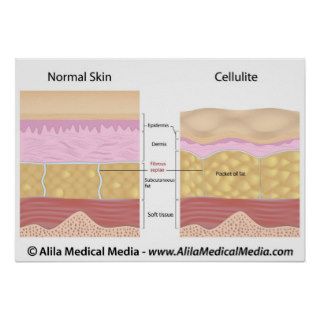 Cellulite versus smooth skin labeled print