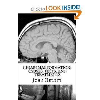 Chiari Malformation Causes, Tests, and Treatments John Hewitt M.A., Michelle Gabata M.D. 9781453895443 Books