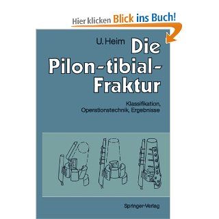 Die Pilon tibial Fraktur Klassifikation, Operationstechnik, Ergebnisse German Edition Urs Heim Bücher